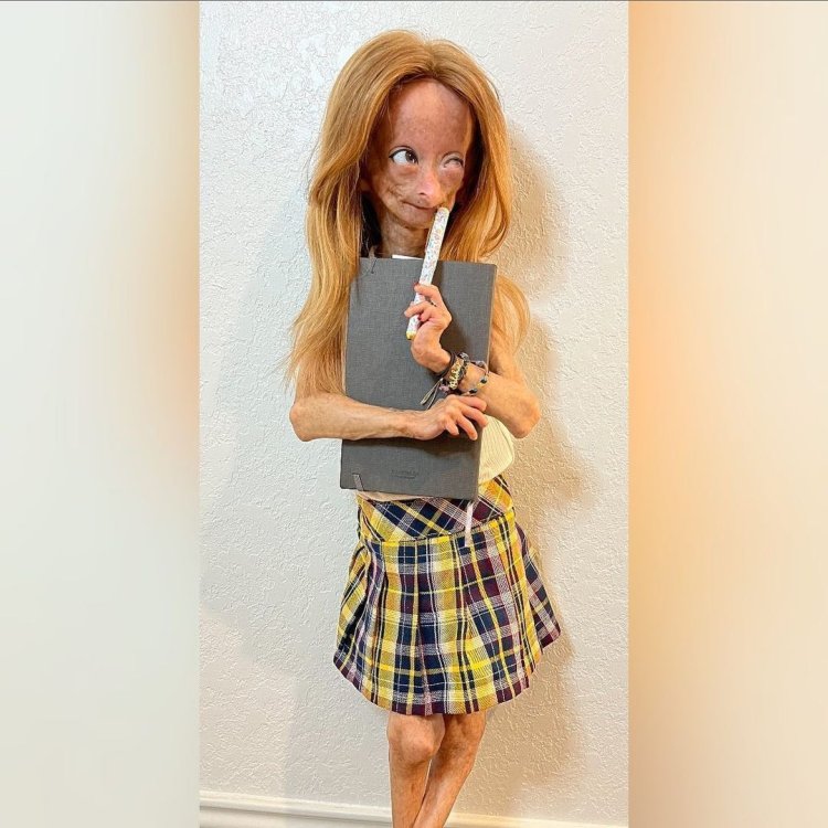 Gilford genchinks syndrome