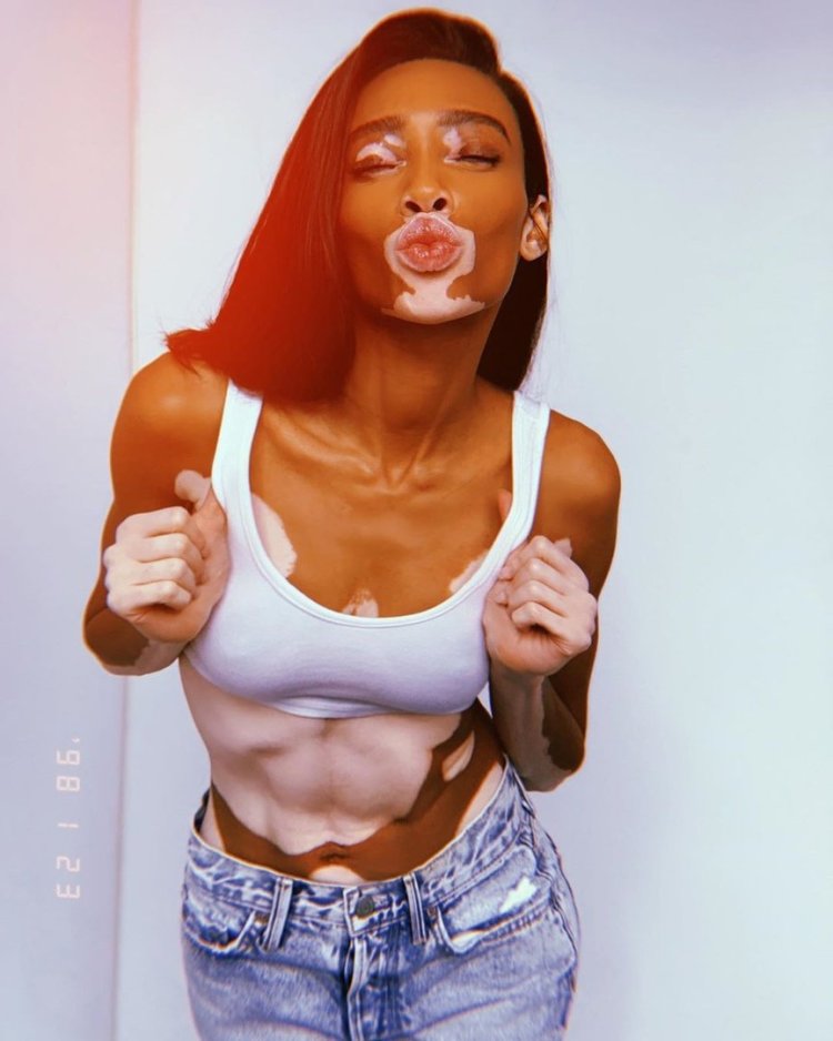 Winnie harlow canadian model