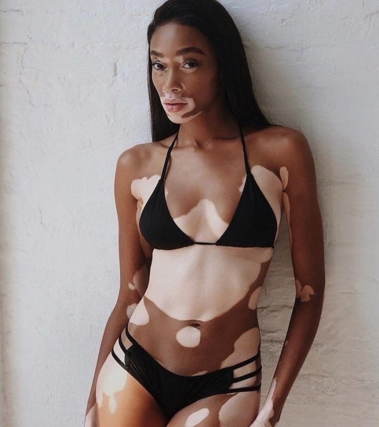 Model with vitiligo Winnie Harlow