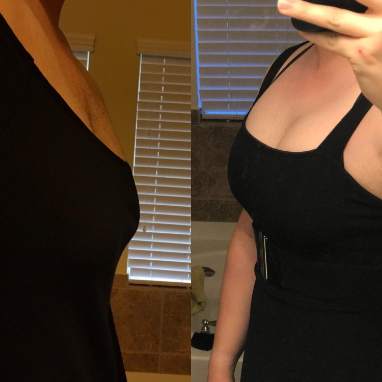 HRT MTF breast growth