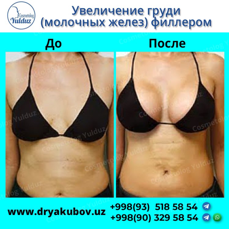 Breast augmentation