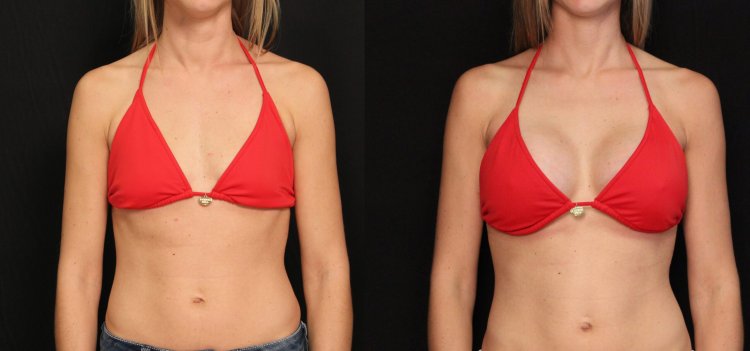 Breast plastic surgery before and after