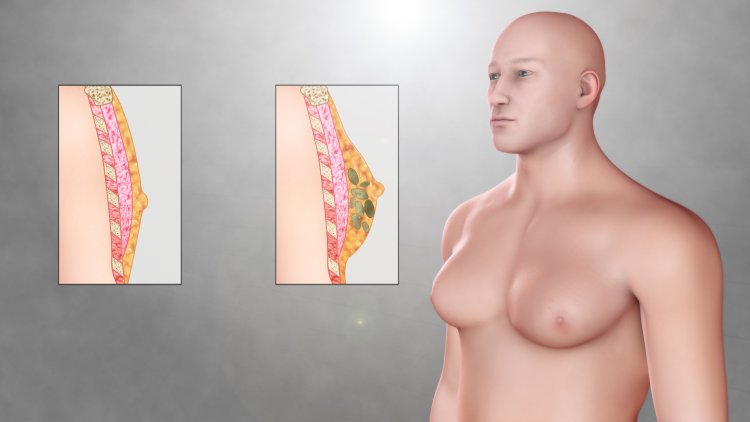 Klinefelter syndrome gynecomastia