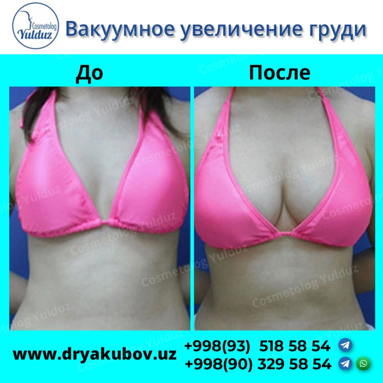 Vacuum breast augmentation