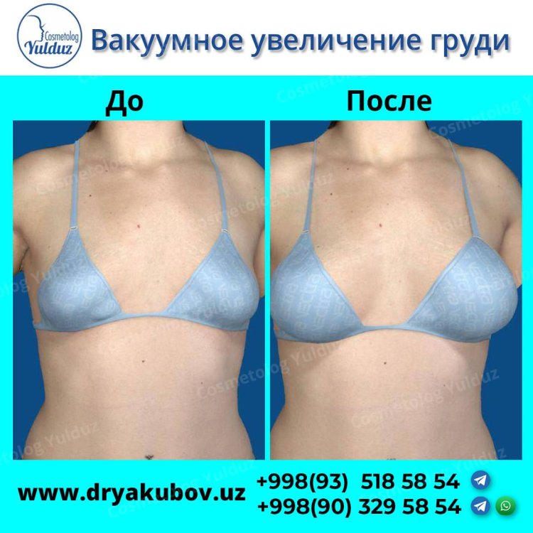 Vacuum Breast Enlarger