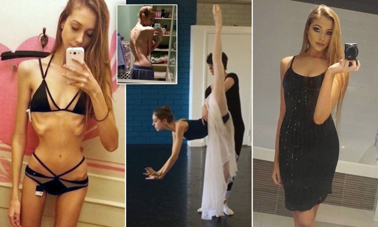 Julia Moskvina anorexia