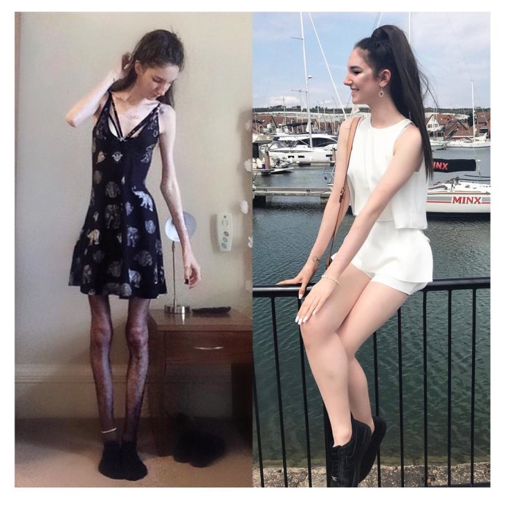 Anorexic girls in dresses