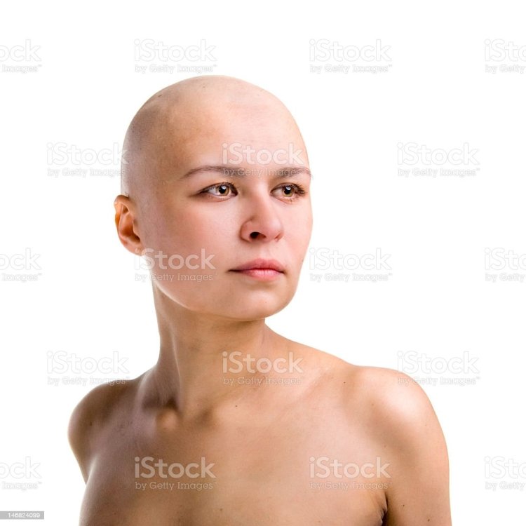 Bald girl