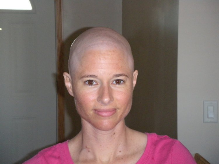 Bald girls alopecia