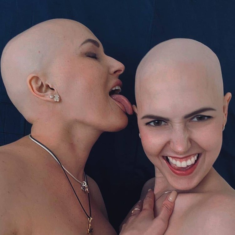 Two bald women