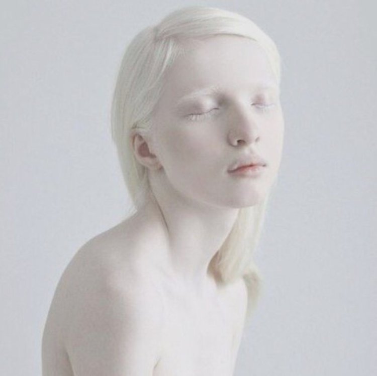 Rosie Crawford Albino
