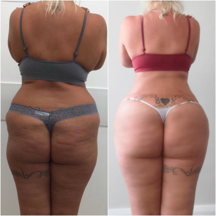Lipomodeling of the buttocks