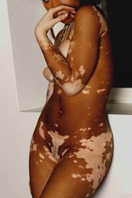 Vitiligo photo of girls nude