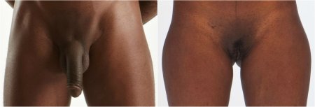 Men with female genitals