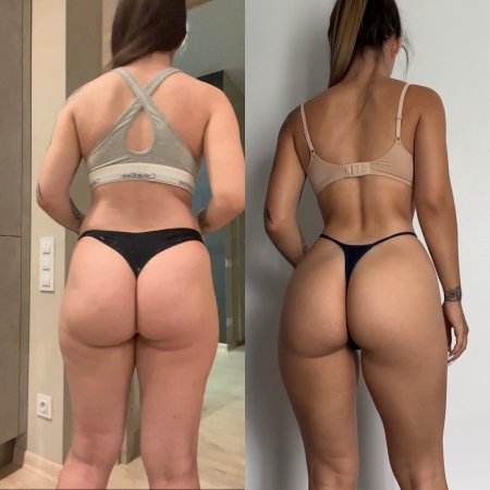 Brazilian Butt Lift BBL