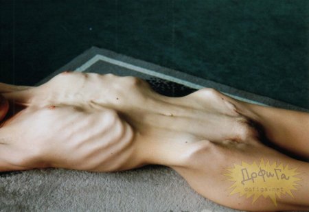 Anorexic naked