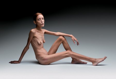 Naked patients with anorexia