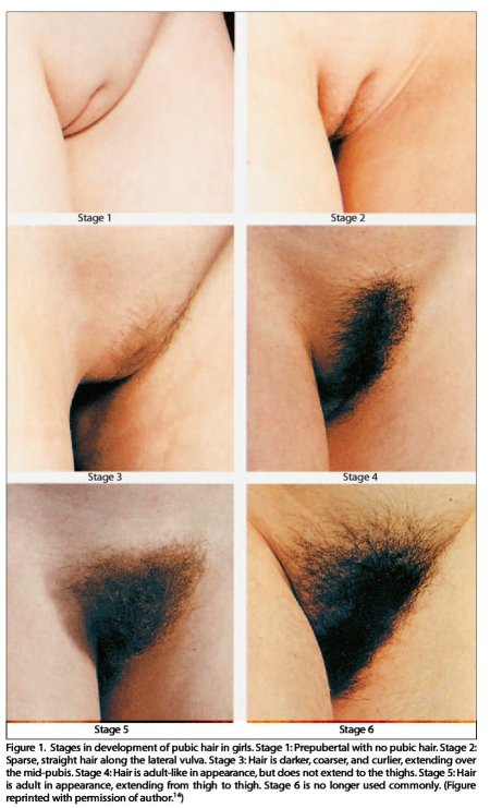 Pubic hair in women